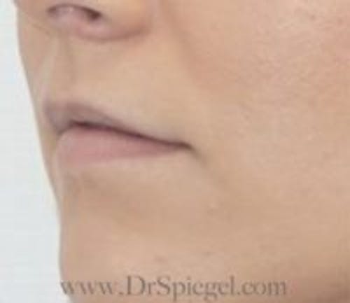 Lip Filler Before & After Gallery - Patient 323584 - Image 3