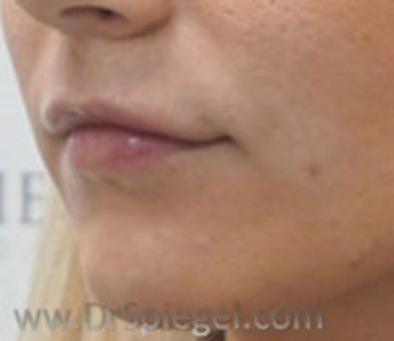 Lip Filler Before & After Gallery - Patient 323584 - Image 4