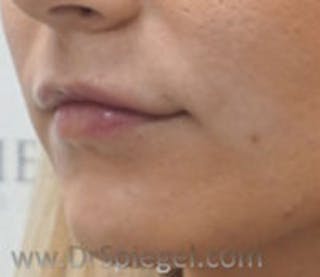 Lip Filler Before & After Gallery - Patient 323584 - Image 4