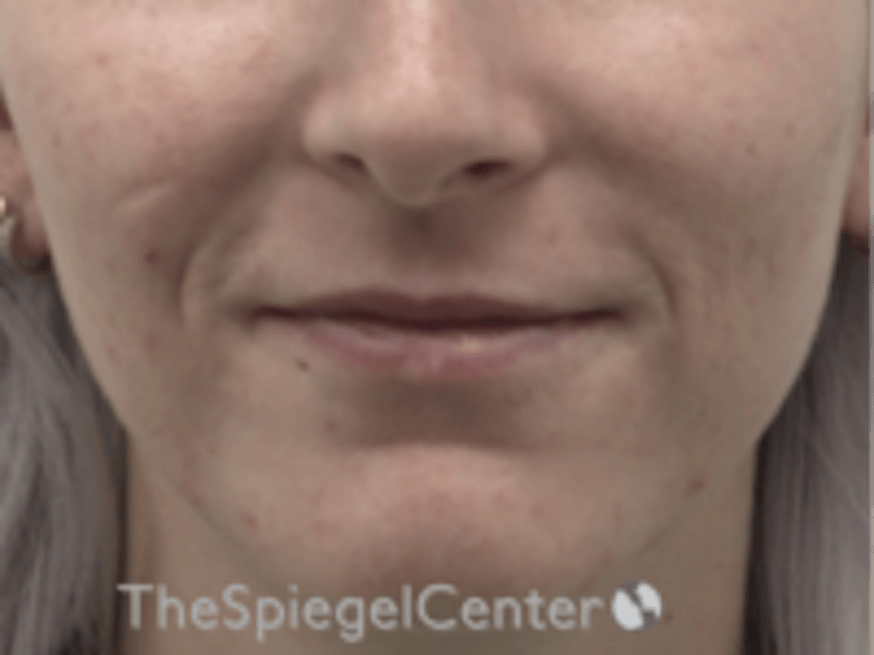 Lip Filler Before & After Gallery - Patient 379481 - Image 1