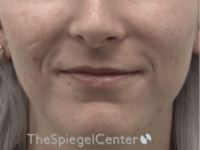 Lip Filler Before & After Gallery - Patient 379481 - Image 1