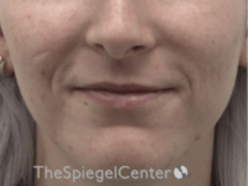 Lip Filler Before & After Gallery - Patient 379481 - Image 1
