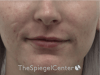 Lip Filler Before & After Gallery - Patient 379481 - Image 2