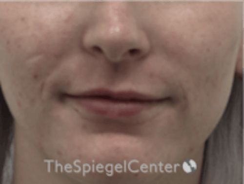 Lip Filler Before & After Gallery - Patient 379481 - Image 2