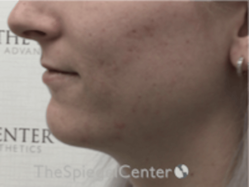 Lip Filler Before & After Gallery - Patient 379481 - Image 3