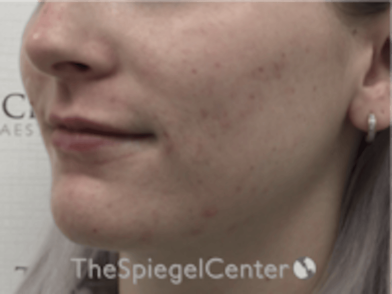 Lip Filler Before & After Gallery - Patient 379481 - Image 4