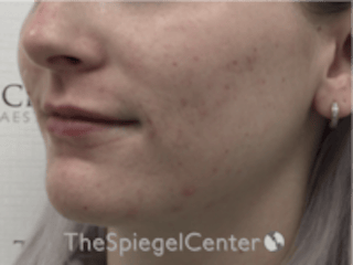 Lip Filler Before & After Gallery - Patient 379481 - Image 4