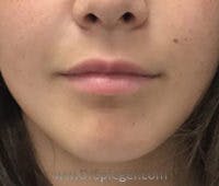 Lip Fillers Before & After Gallery - Patient 221086 - Image 1