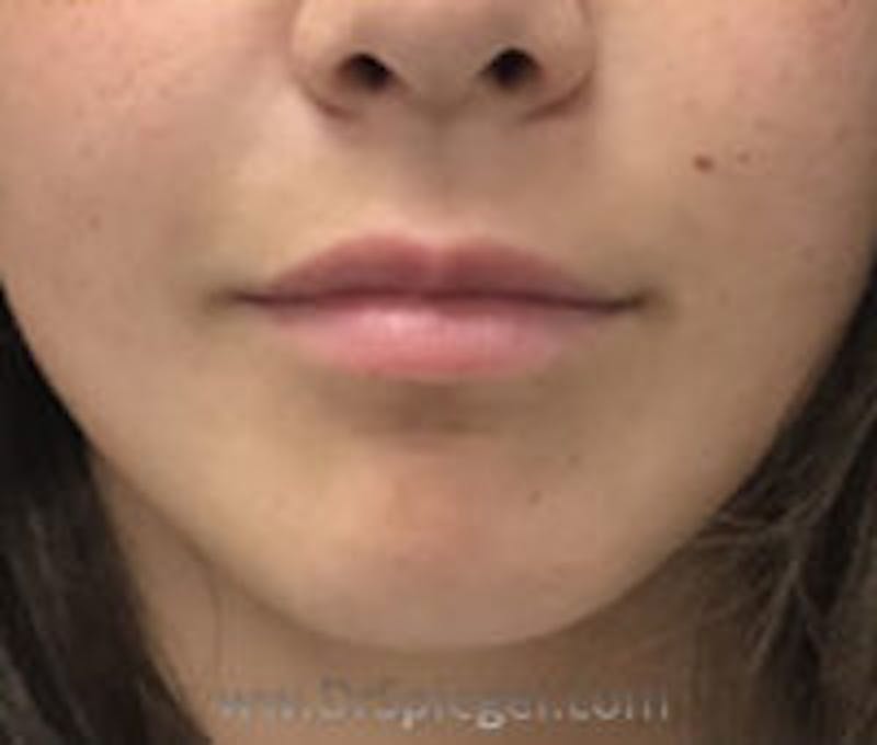 Lip Filler Before & After Gallery - Patient 409792 - Image 1
