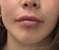 Lip Fillers Before & After Gallery - Patient 221086 - Image 2
