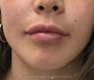 Lip Filler Before & After Gallery - Patient 409792 - Image 2