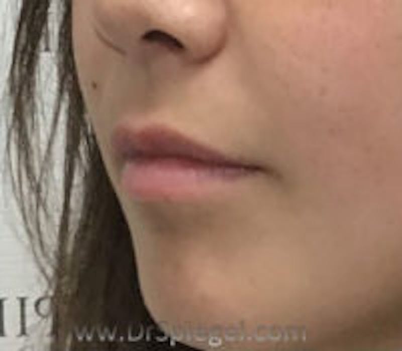 Lip Filler Before & After Gallery - Patient 409792 - Image 3