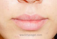 Lip Filler Before & After Gallery - Patient 408916 - Image 1