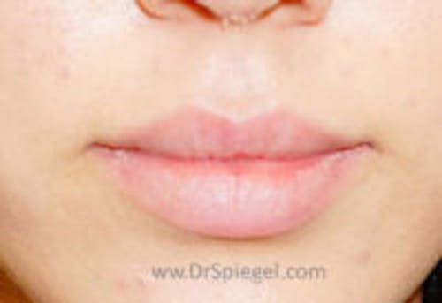 Lip Filler Before & After Gallery - Patient 408916 - Image 1
