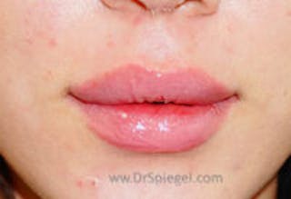 Lip Filler Before & After Gallery - Patient 408916 - Image 2