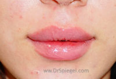Lip Filler Before & After Gallery - Patient 408916 - Image 2