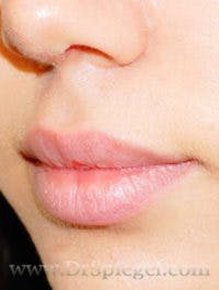 Lip Filler Before & After Gallery - Patient 408916 - Image 3