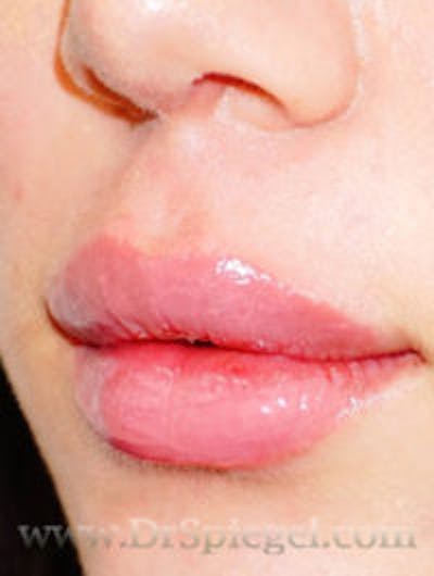 Lip Filler Before & After Gallery - Patient 408916 - Image 4