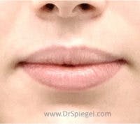 Lip Filler Before & After Gallery - Patient 102386 - Image 1