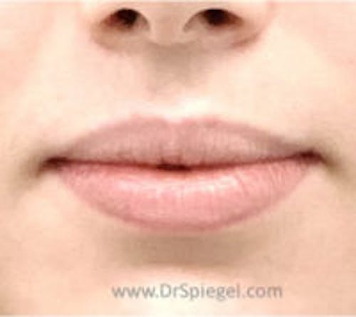Lip Filler Before & After Gallery - Patient 102386 - Image 1