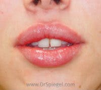 Lip Filler Before & After Gallery - Patient 102386 - Image 2