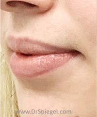 Lip Filler Before & After Gallery - Patient 102386 - Image 3