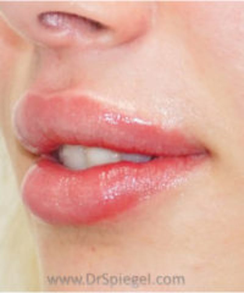 Lip Filler Before & After Gallery - Patient 102386 - Image 4