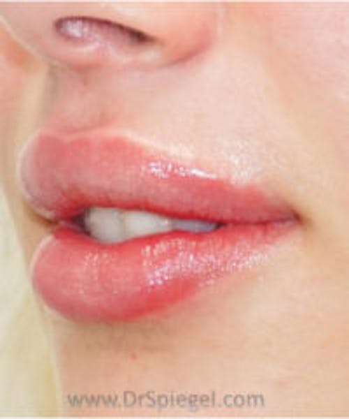 Lip Filler Before & After Gallery - Patient 102386 - Image 4