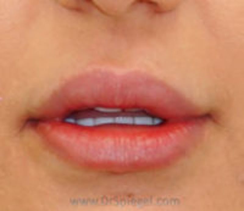 Lip Filler Before & After Gallery - Patient 130578 - Image 1