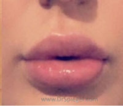 Lip Filler Before & After Gallery - Patient 130578 - Image 2