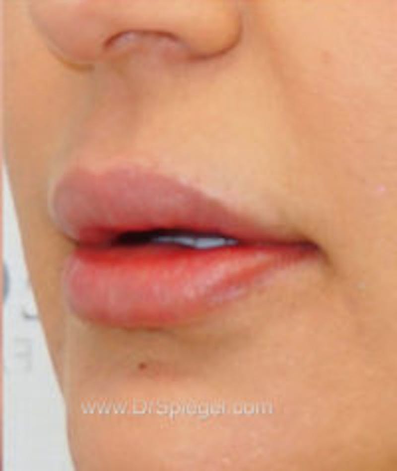 Lip Filler Before & After Gallery - Patient 130578 - Image 3