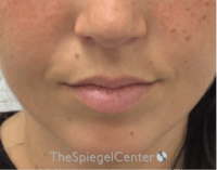 Lip Filler Before & After Gallery - Patient 682522 - Image 1