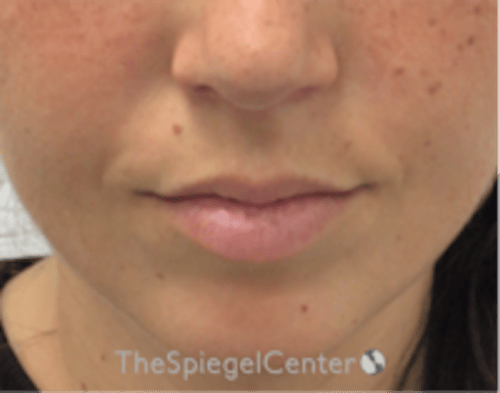Lip Filler Before & After Gallery - Patient 682522 - Image 1