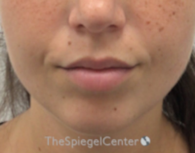 Lip Filler Before & After Gallery - Patient 682522 - Image 2