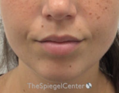 Lip Filler Before & After Gallery - Patient 682522 - Image 2