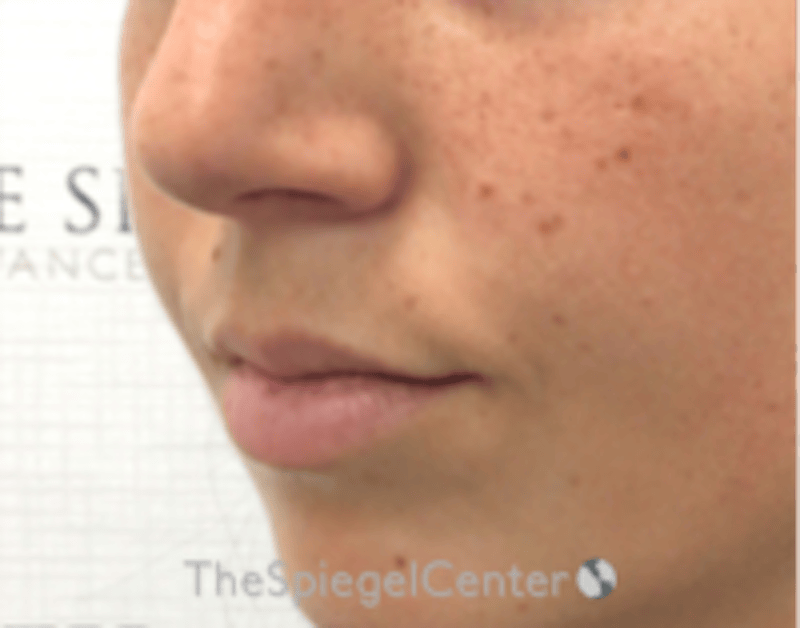 Lip Filler Before & After Gallery - Patient 682522 - Image 3