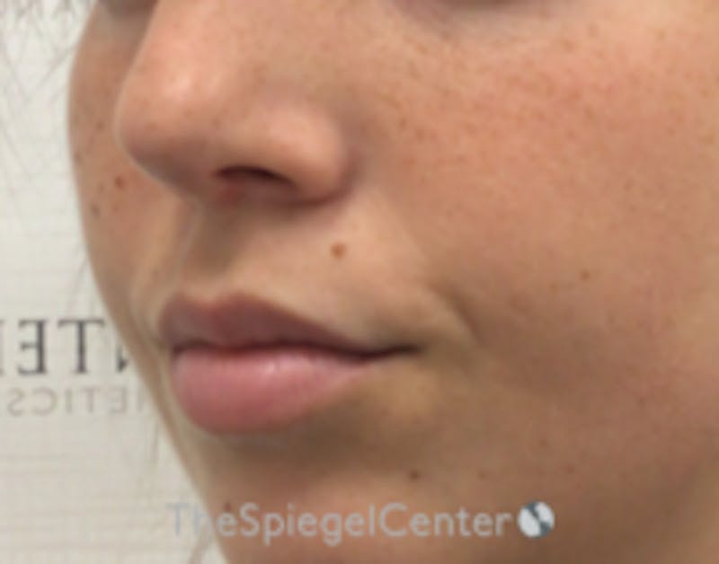 Lip Filler Before & After Gallery - Patient 682522 - Image 4
