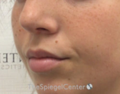 Lip Filler Before & After Gallery - Patient 682522 - Image 4