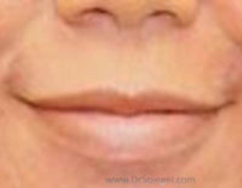 Lip Filler Before & After Gallery - Patient 687464 - Image 1