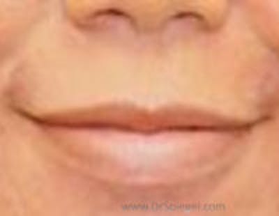 Lip Filler Before & After Gallery - Patient 687464 - Image 1