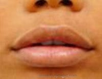 Lip Filler Before & After Gallery - Patient 687464 - Image 2