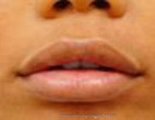 Lip Filler Before & After Gallery - Patient 687464 - Image 2