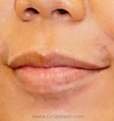 Lip Filler Before & After Gallery - Patient 687464 - Image 3