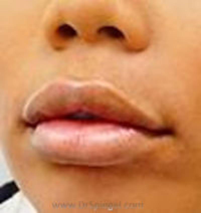 Lip Filler Before & After Gallery - Patient 687464 - Image 4