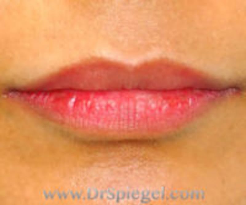 Lip Filler Before & After Gallery - Patient 276121 - Image 1