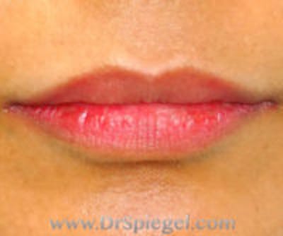 Lip Filler Before & After Gallery - Patient 276121 - Image 1