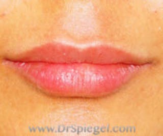 Lip Filler Before & After Gallery - Patient 276121 - Image 2