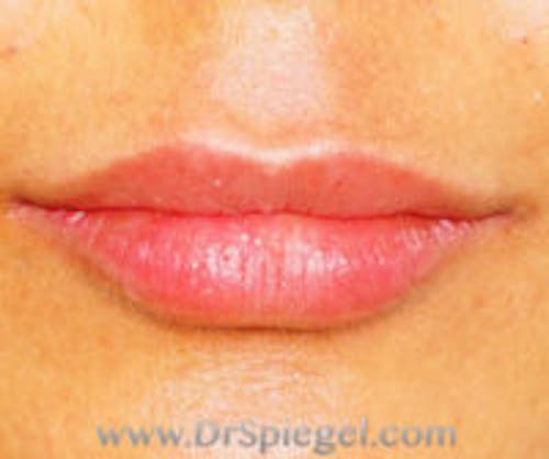 Lip Filler Before & After Gallery - Patient 276121 - Image 2