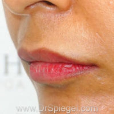 Lip Filler Before & After Gallery - Patient 276121 - Image 3