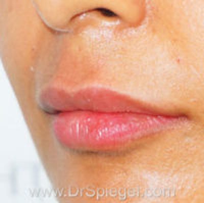 Lip Filler Before & After Gallery - Patient 276121 - Image 4